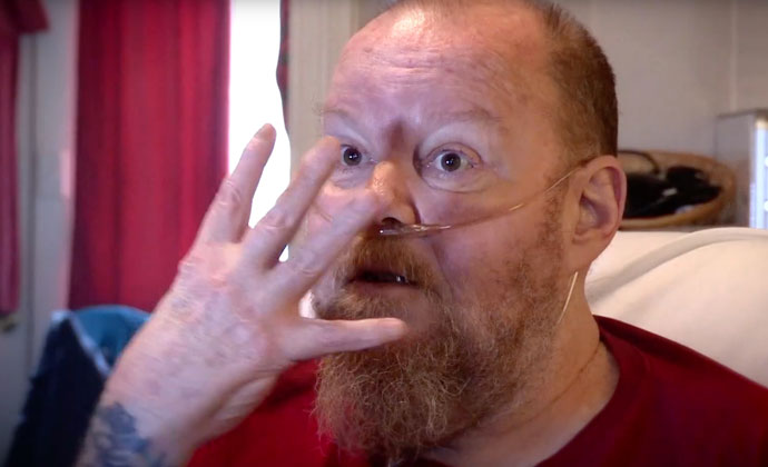 Ipinapaliwanag ng isang lalaki kung paano siya nasunog dahil sa maling paggamit ng oxygen